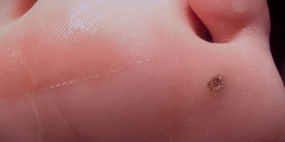 Especialista en Virus del Papiloma Humano